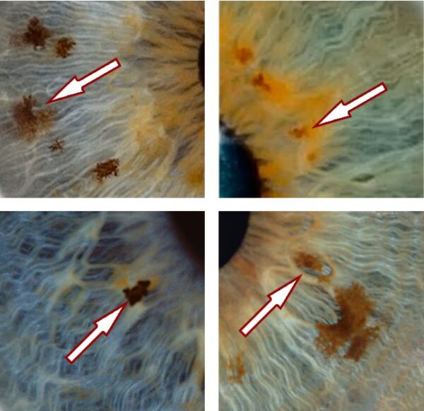 Iris Identification Behavioral Iridology